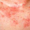 Eczema. Imagem: (Divulgação)