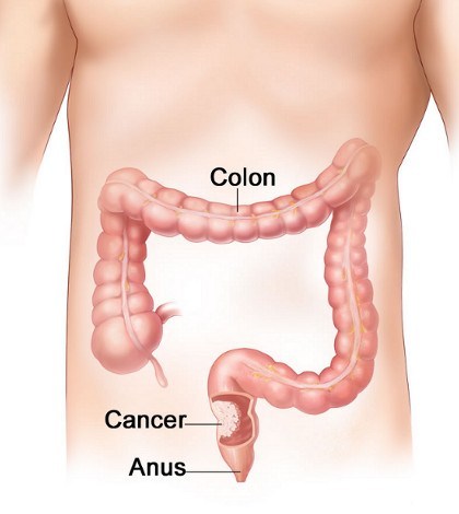 Cancer de colon resumen