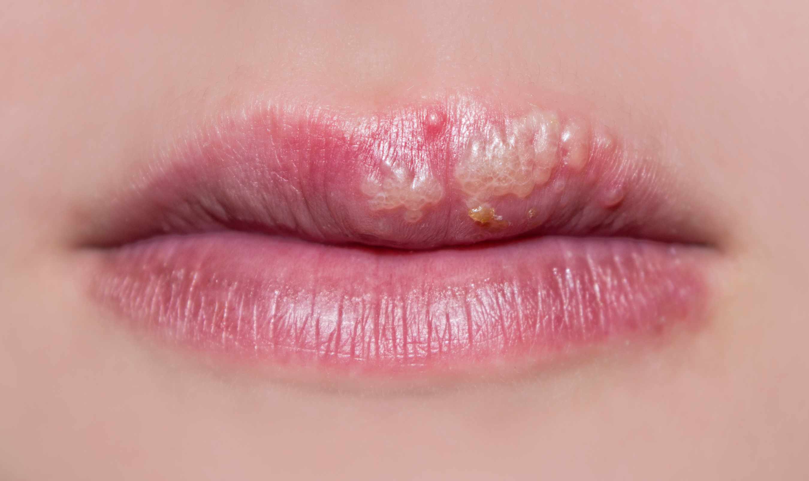 Herpes Labial – Como tratar as feridas na boca?