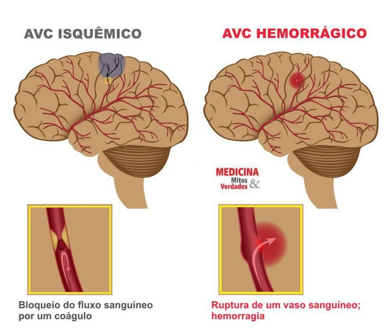 Derrame por que acontece? É possível evitar? | Dr. Juliano Pimentel