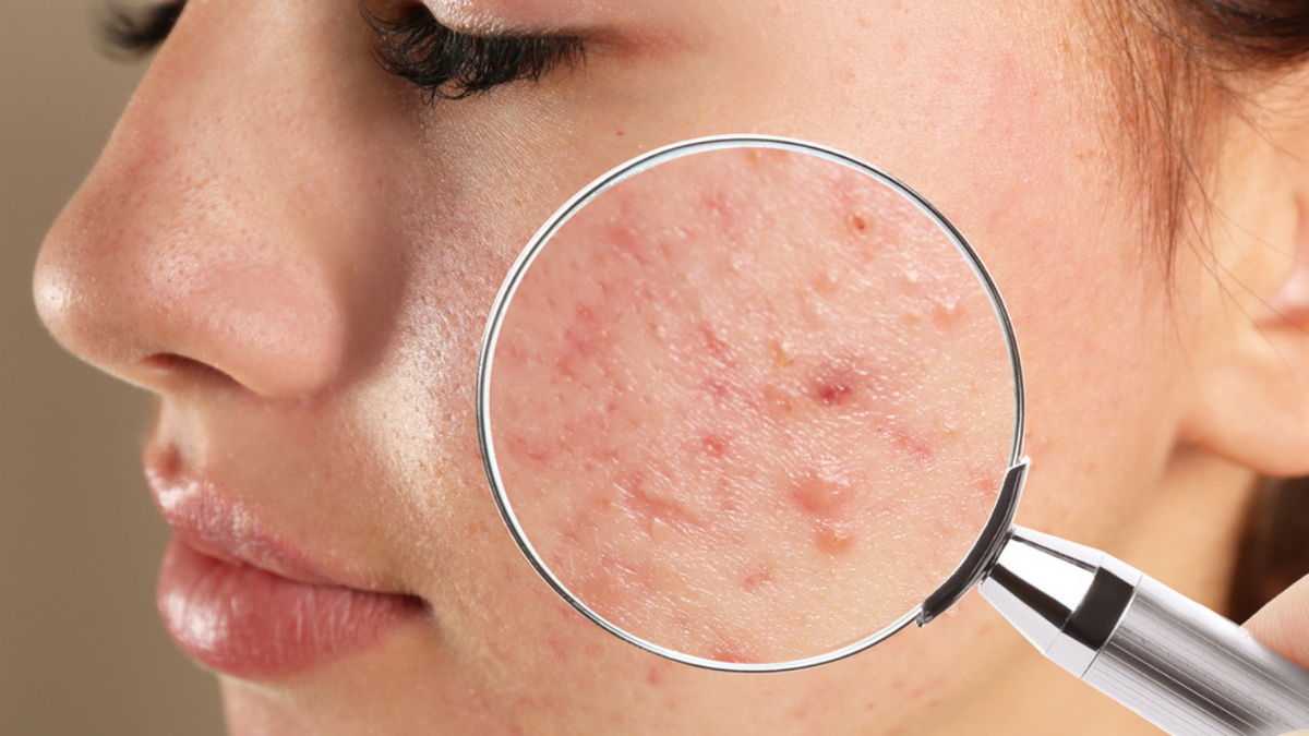 Mapeamento facial: a real causa da acne